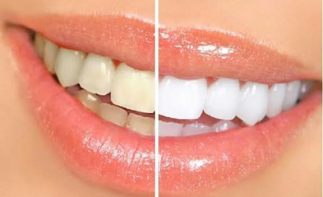 لبخند و سفید کردن دندان