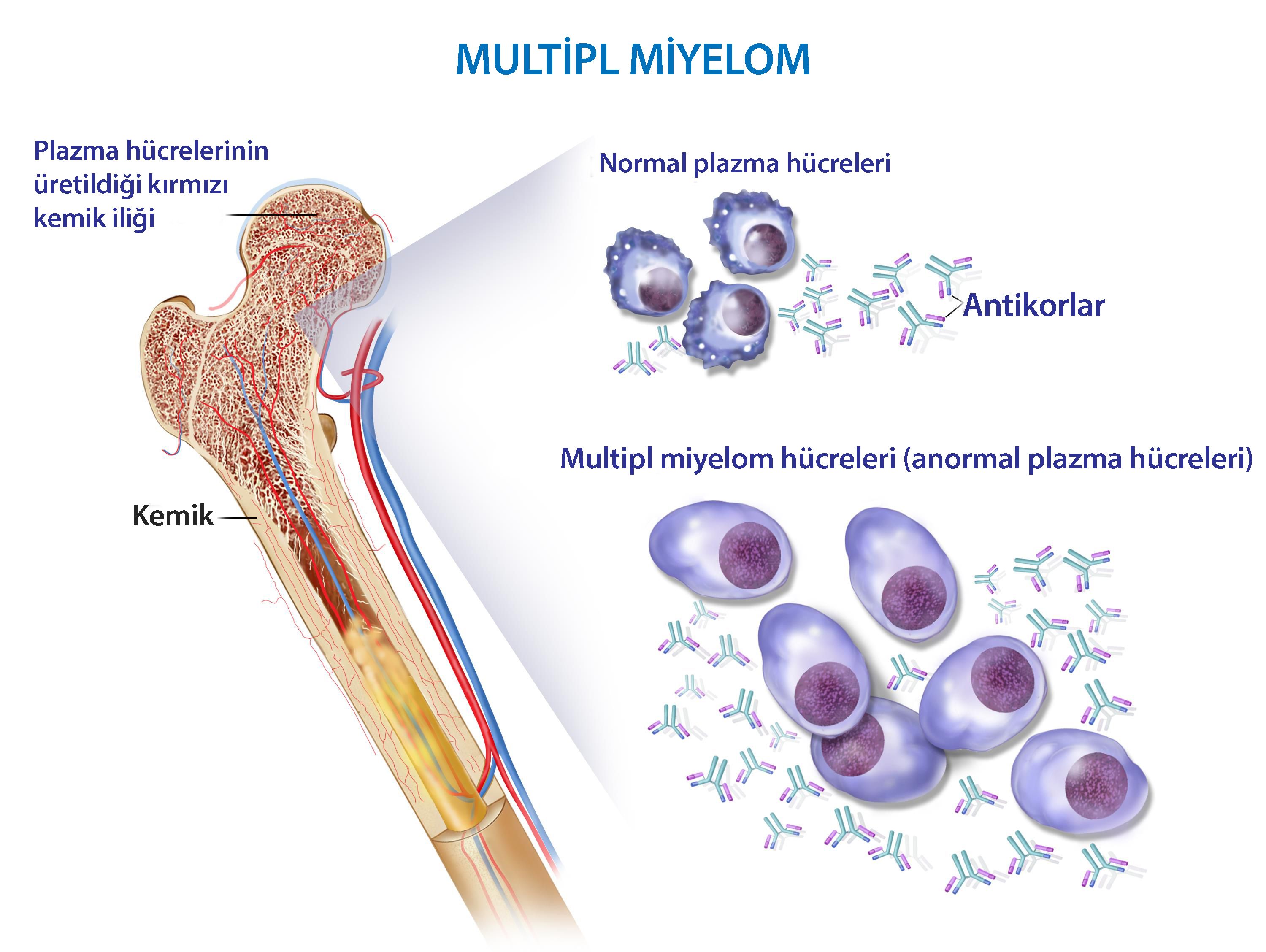 سرطان مولتیپل میلوما