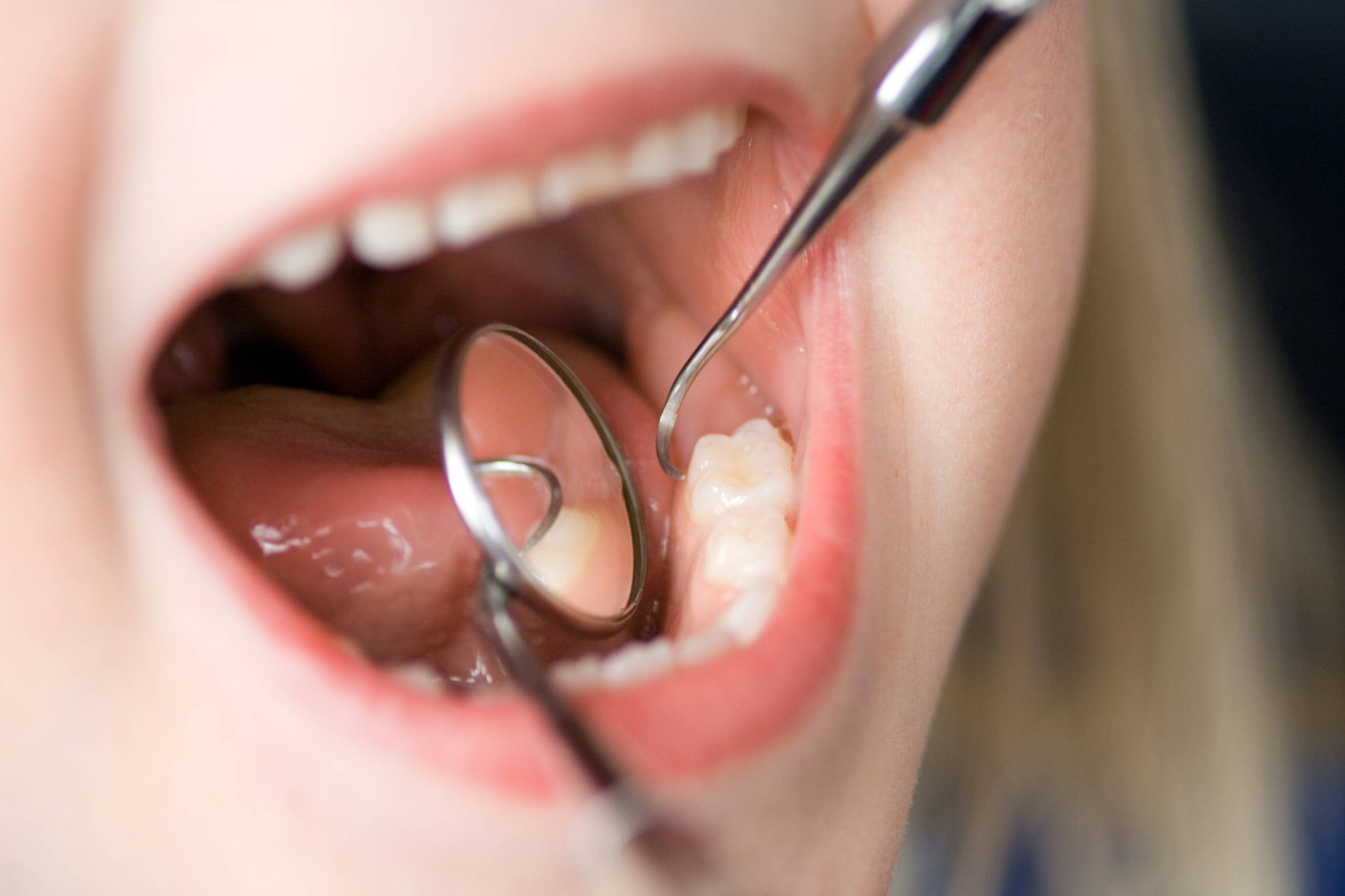 دهان و دندان و پوسیدگی دندان