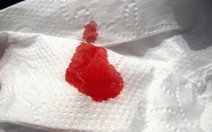 خونریزی مقعدی و دستمال خونی