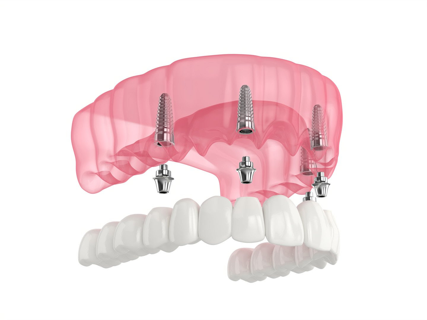 مزایای ایمپلنت دندان برای فک بالا